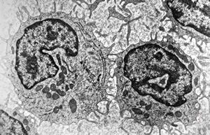 M,33y. | blood - hairy cell leukemia